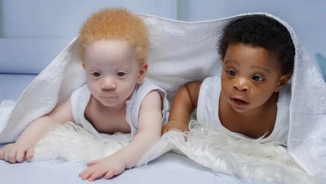 Born Minutes Apart, but One Twin's Shocking Difference Left the World Stunned!